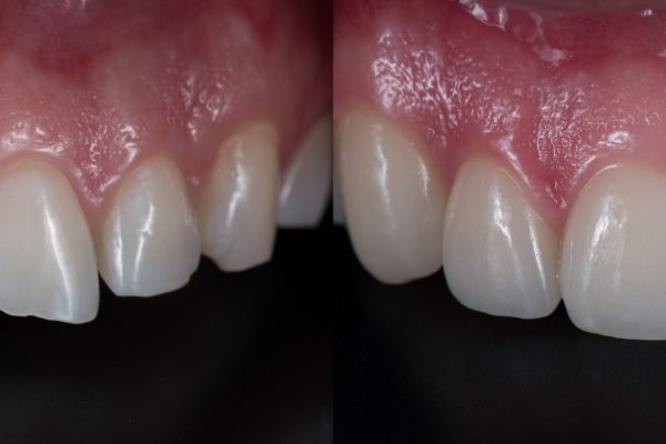 Treatment,For,Front,Teeth,Fracture,With,Dental,Ceramic,Veneers.