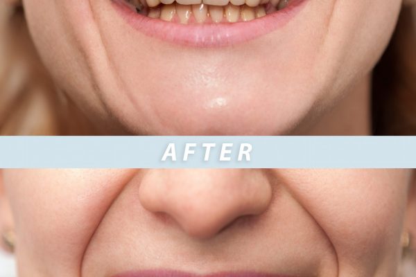 Woman,Teeth,Before,And,After,Dental,Treatment.,Teeth,Whitening.,Happy