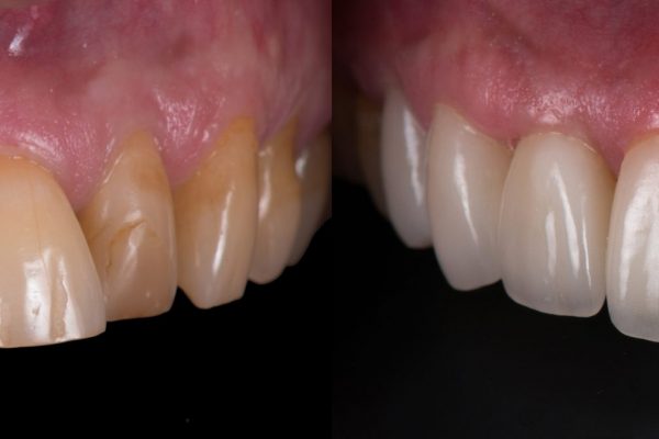 Dental,Crown,And,Veneer,Before,And,After.,Smile,Makeover,With